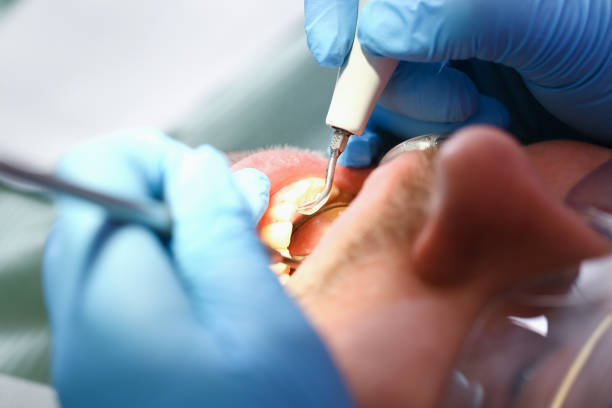 Best Knocked-Out Tooth Emergency  in Bourbon, MO